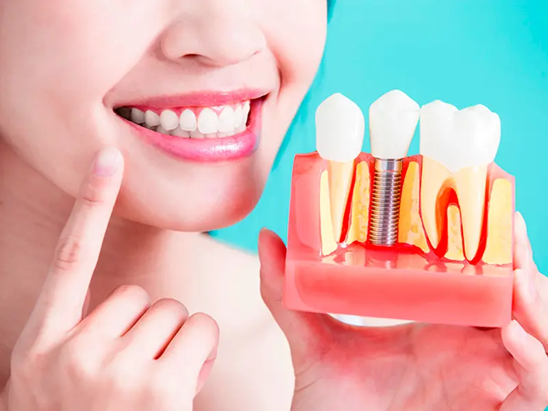 Implantes